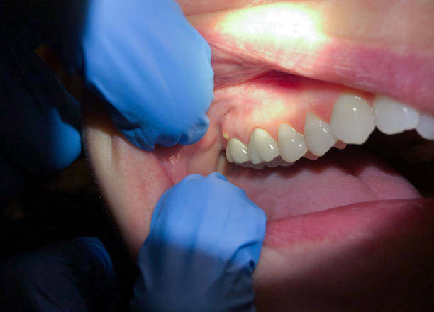 Best Urgent Care for Lost Fillings or Crowns in Langley, WA
